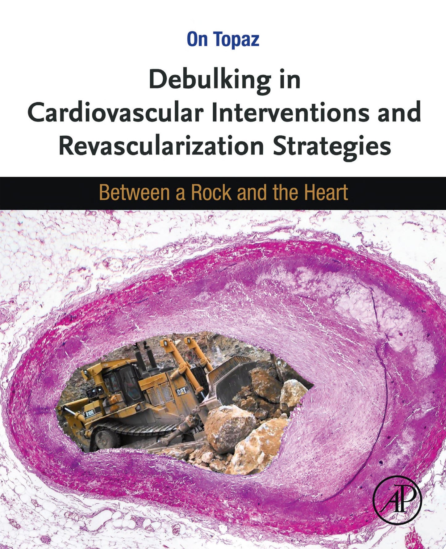 Debulking in Cardiovascular Interventions and Revascularization Strategies: Between a Rock and the Heart
