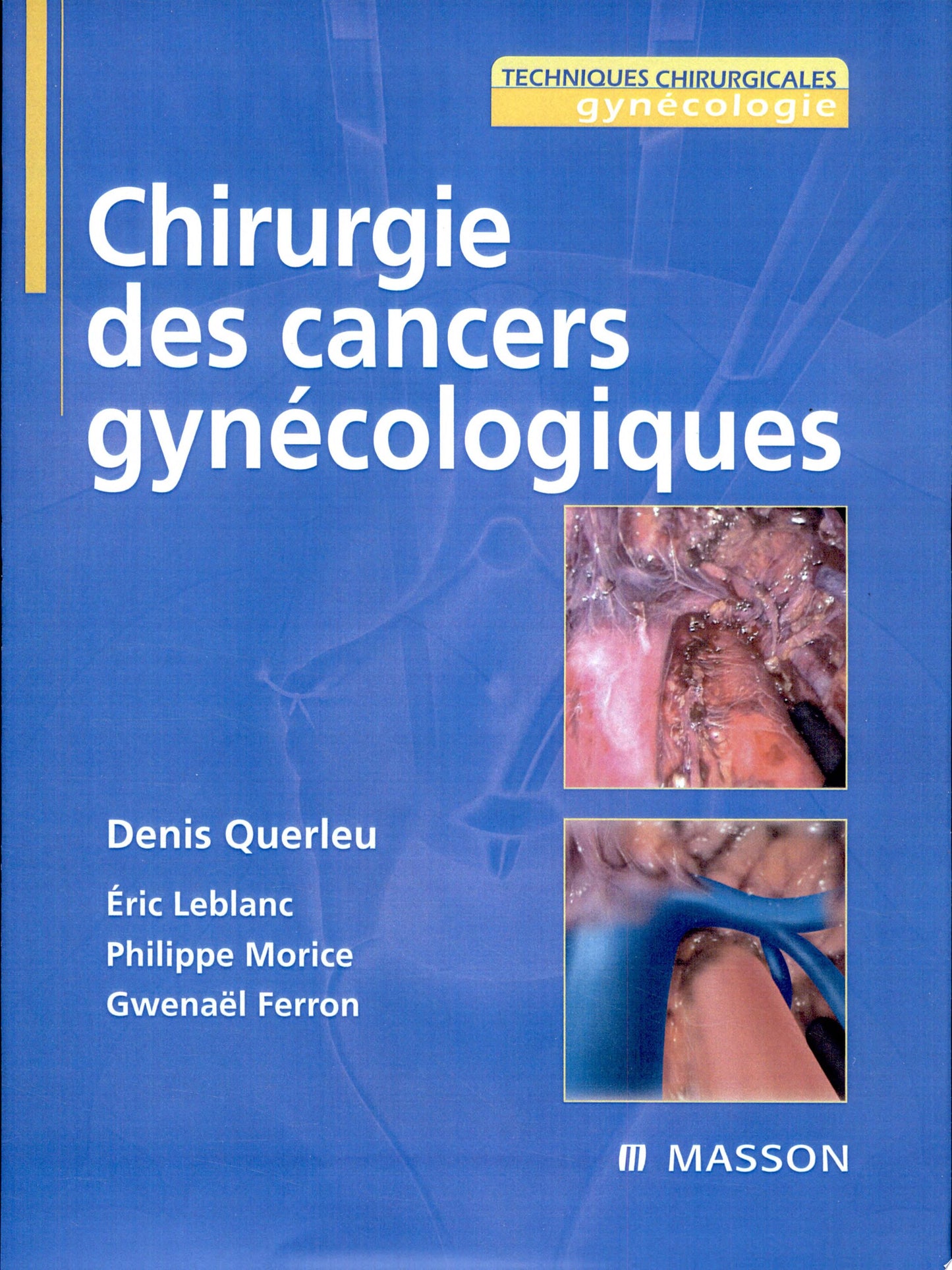 Chirurgie des cancers gynécologiques 2e