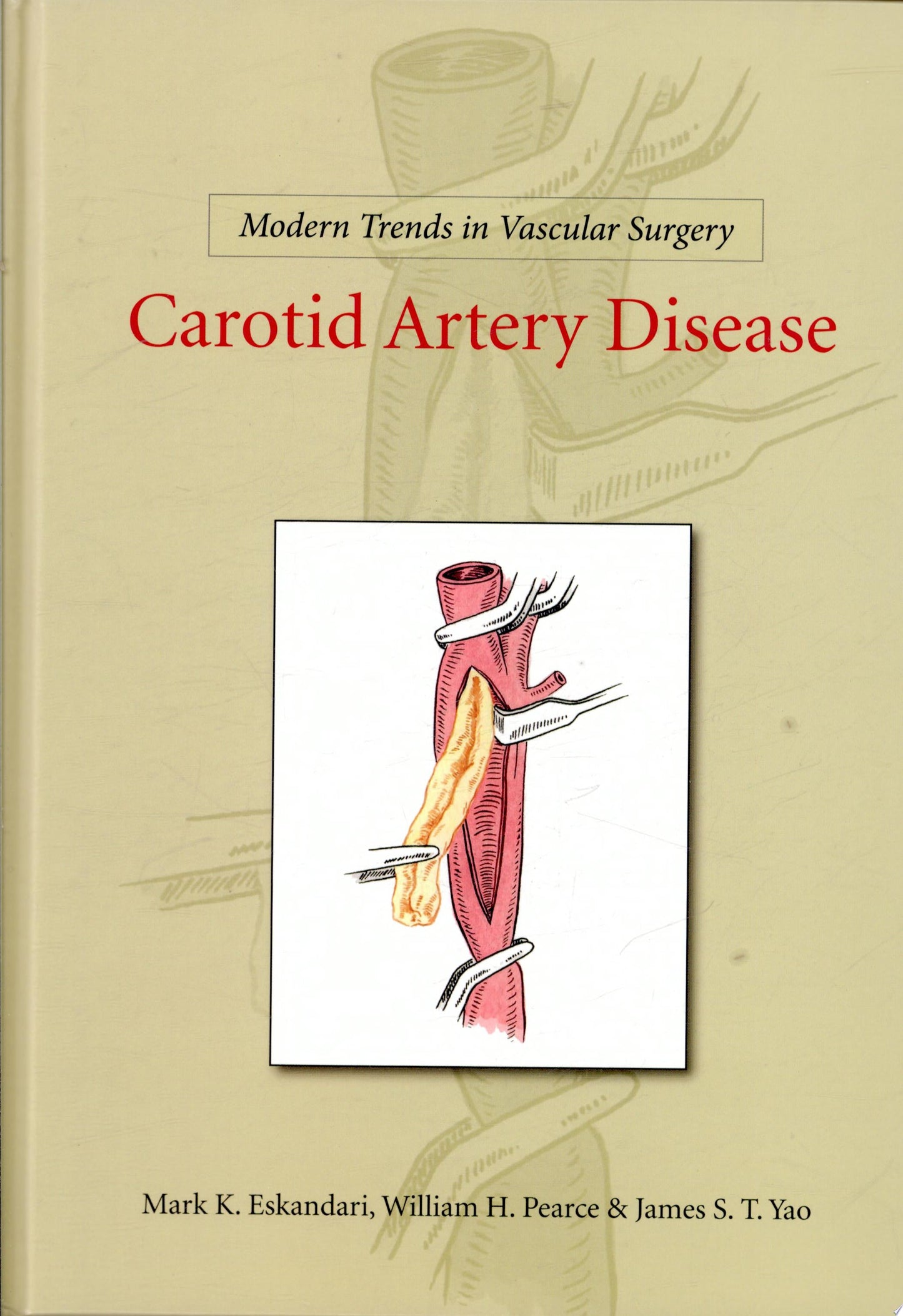 Modern Trends in Vascular Surgery: Carotid Artery Disease